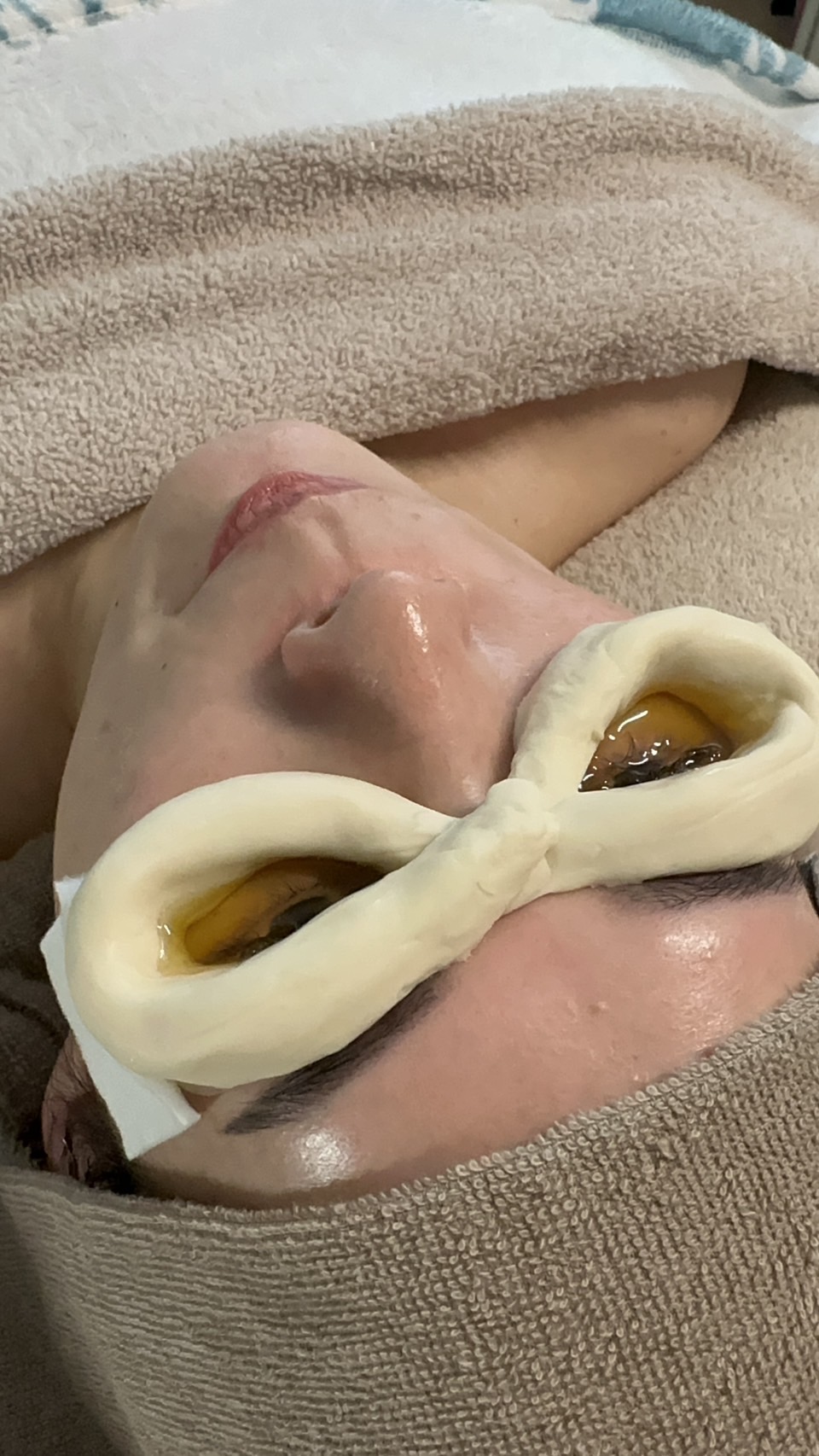 ネトラバスティ施術